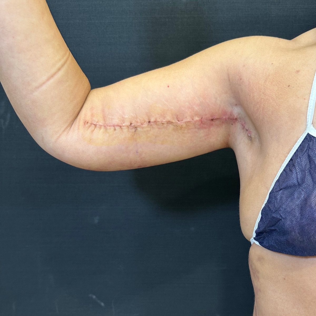 Arm lift (brachioplasty), after