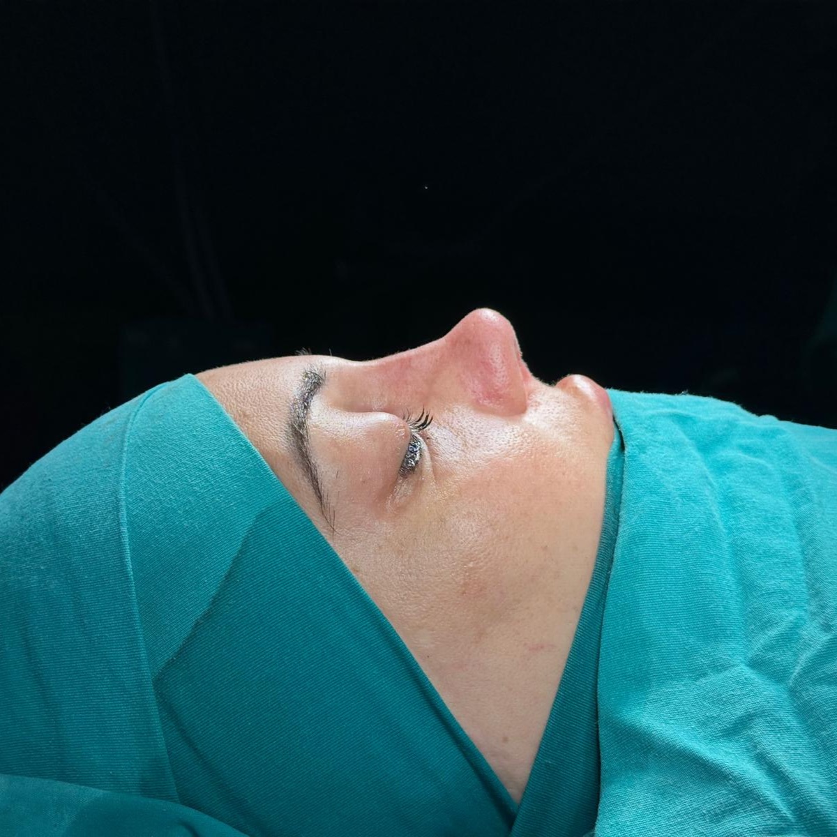 Rhinoplasty, after