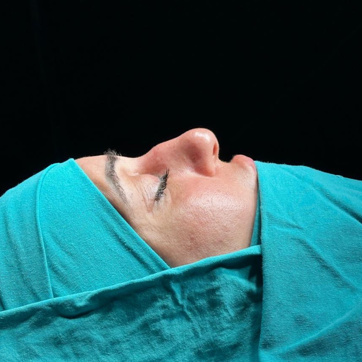 Rhinoplasty, before