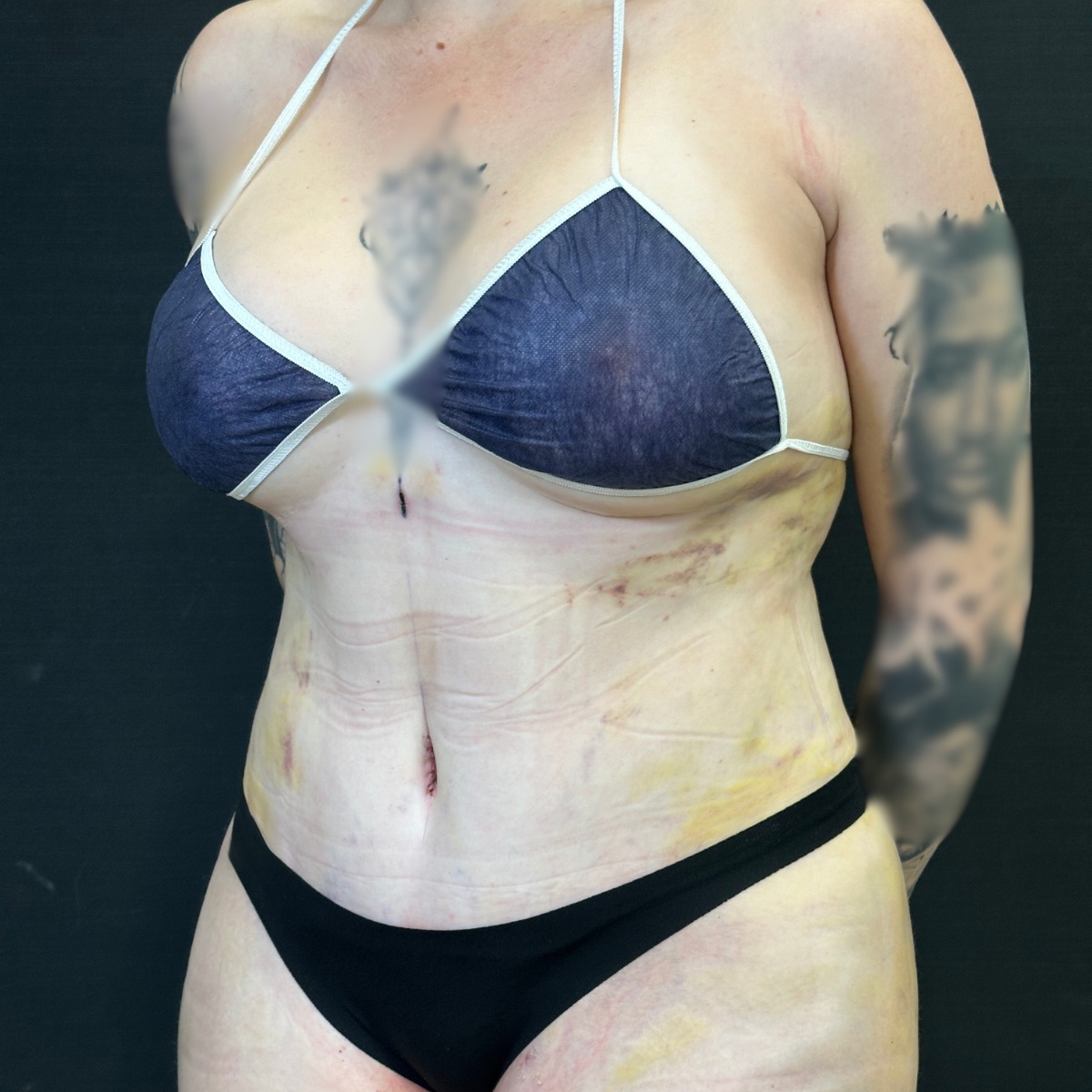 Tummy tuck with 360 liposuction, 4 days after surgery