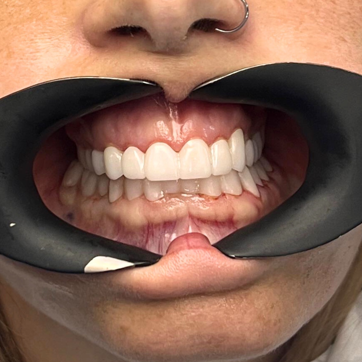 E-max veneers, after