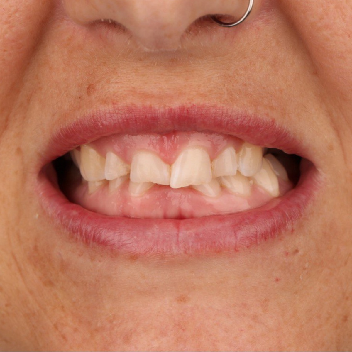 E-max veneers, before